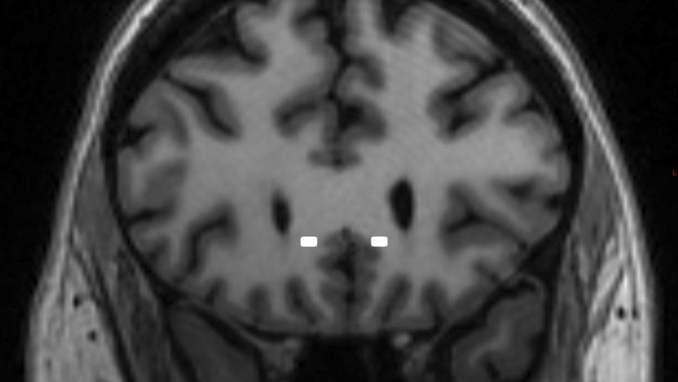 This brain scan image provided by Mount Sinai in 2024 shows the targeted sites for electrodes implanted in patient Emily Hollenbeck for use with deep brain stimulation therapy. (Mount Sinai via AP)